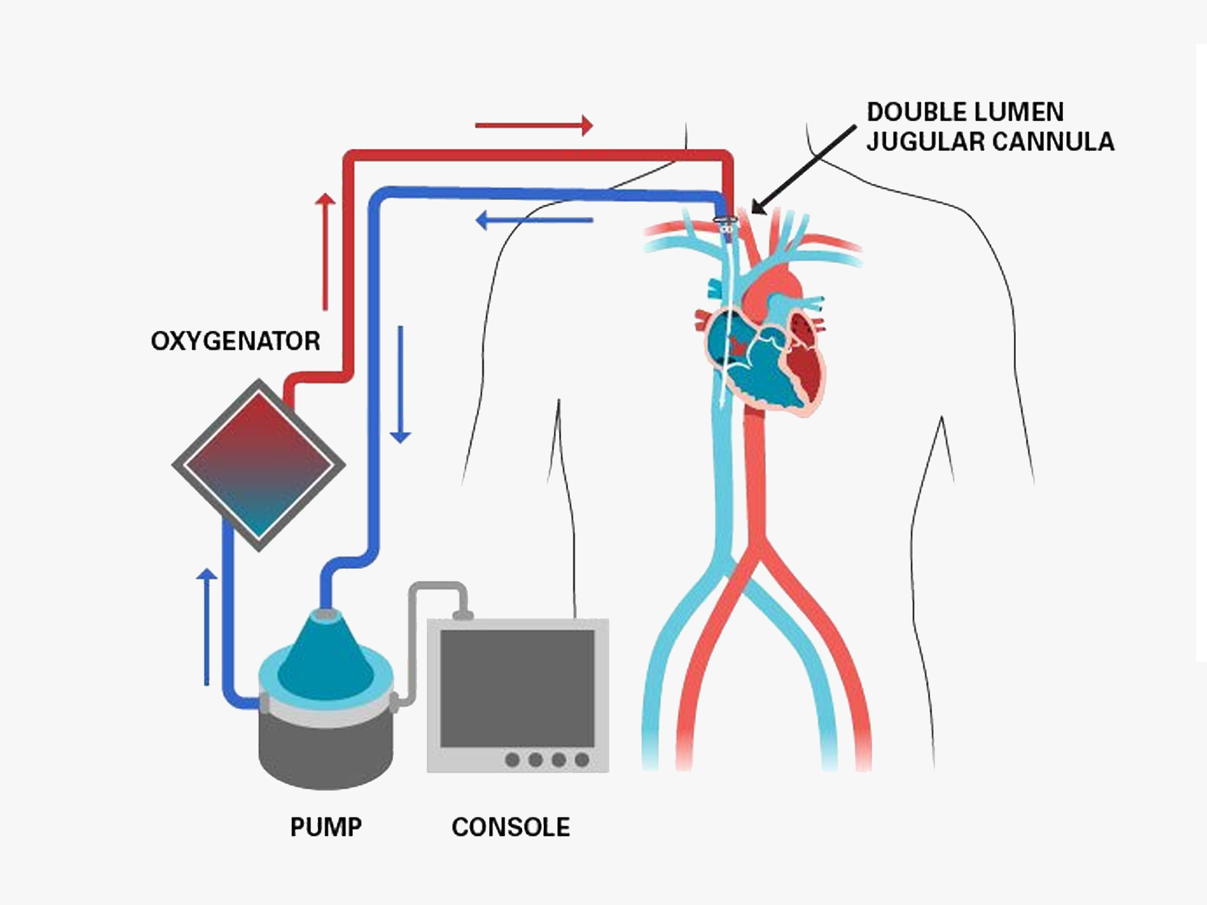 氧合器套包（ECMO）